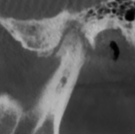 Сустав с артрозом: ВНЧС больной 1.png