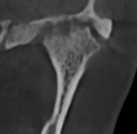 Сустав с артрозом: ВНЧС больной 3.png