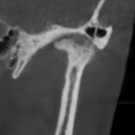 Сустав с артрозом: ВНЧС больной 6.png